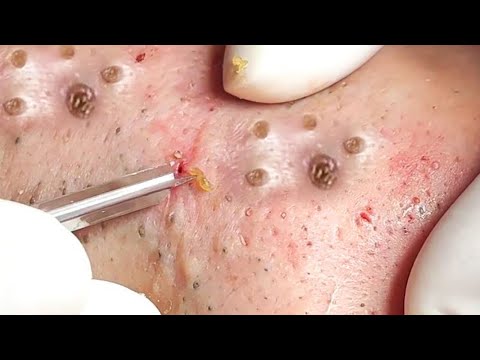 Pimple Blackheads Maggot Popping removal #satisfying #blackheads #pimple