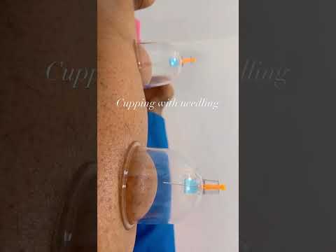 Dry needling with cupping. The purpose of this technique is to increase ROM,improve healing.