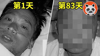 核輻射死亡83天全紀錄，看著自己融化是種什麼體驗？他遭受2萬倍的輻射量，世界上死的最慘的人【🐼熊貓周周】