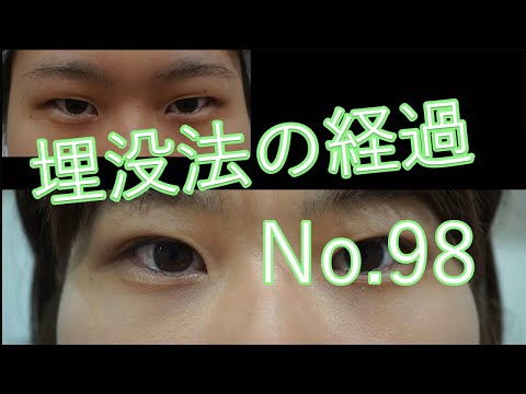 二重まぶた埋没法2点（ループ）止め　モニターさん1か月目の経過　98