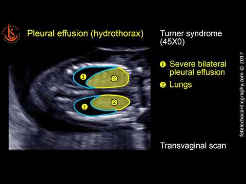 Fetal echocardiography at 11-13 weeks: Pleural Effusion (Hydrothorax)