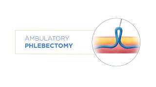 Varicose Vein Treatment - Ambulatory Phlebectomy