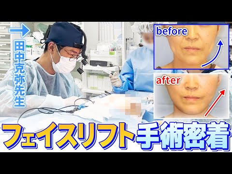 【手術密着】フェイスリフト手術の当日の様子を大公開