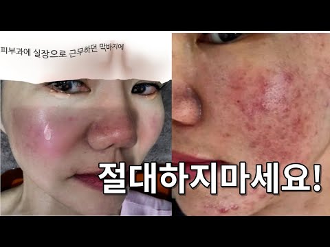 전직피부과실장의 시술부작용 ㅠ 나의스토리 내피부를 되돌리기위해 했던 세가지방법!