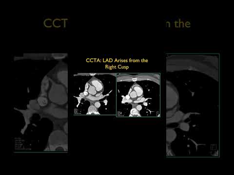 CCTA: LAD Arises from the Right Cusp