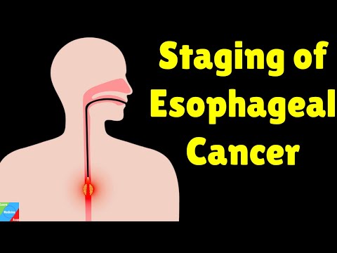 Esophageal Cancer Staging | TNM Staging for Esophageal Cancer | AJCC Staging System