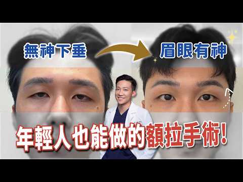 「都是你帶衰！」眉開+大眼 只做一手術！告別垂眼疲態👀內視鏡提眉五爪前額拉提 雙眼悄悄變有神Ft.@heroh205  ｜依心唯美 林子宇醫師