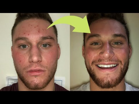 TOP 3 INGREDIENTS For CLEAR SKIN FAST (Get Rid Of ACNE)