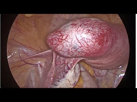 Laparoscopic Surgery for Cornual (ECTOPIC) pregnancy Rooma Sinha Apollo Hyderabad