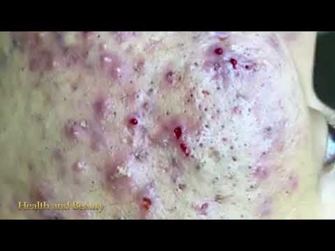 Ance Remove - Blackheads Removal - Best Pimple Popping (Part 01)