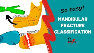 Mandibular Fracture Classification | DENTAL NOTES