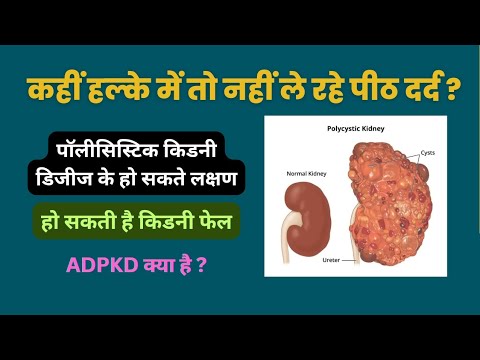 Polycystic kidney disease || What is polycystic kidney disease || DR STETHO MBBS MD Medicine || PKD