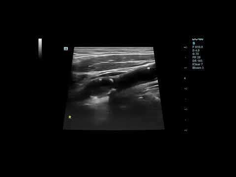 Occluded internal carotid artery Ultrasound Image and Video #shortsvideo