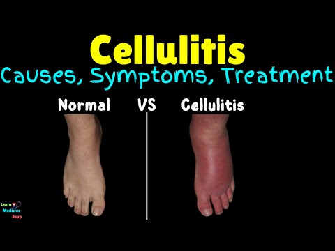 Cellulitis: Symptoms, Causes, Treatment & Prevention