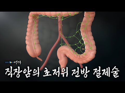 [명의 의학백과📖] 직장암의 초저위 전방 절제술