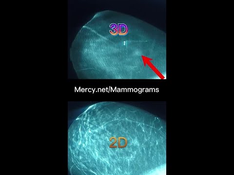 2D v 3D Mammograms