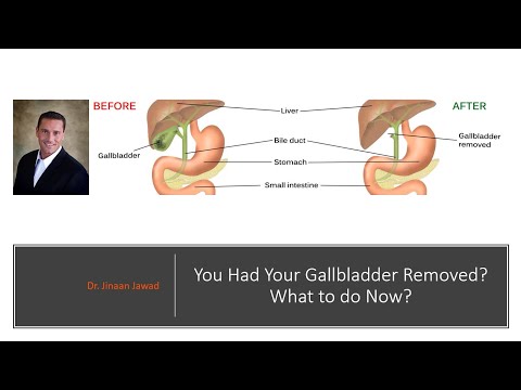 Gallbladder Removed: What To Do Now?