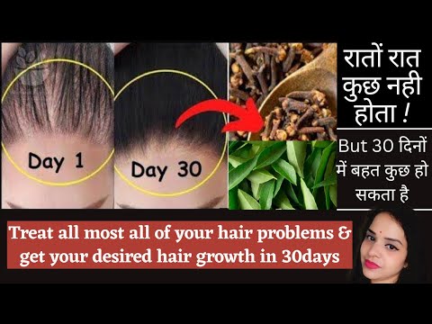 लौंग/clove को इस तरह से use करिए to stop excessive hair loss, treat bald ness & extreme hair growth.