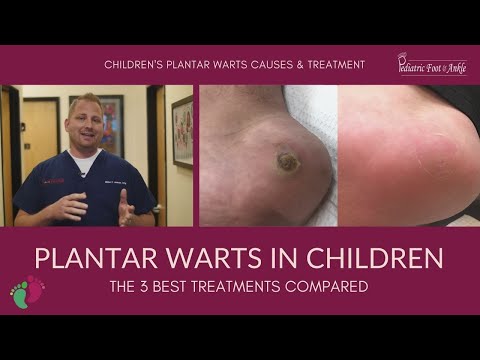 Plantar Warts in Children The 3 Best Treatments Compared