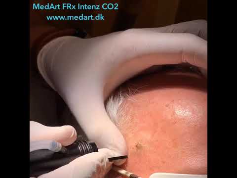 Laser Treatment of age spot