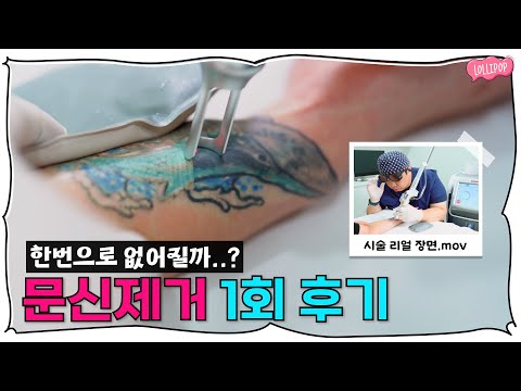 한번으로 얼만큼 지워질까..? 레이저로 컬러문신 지우는 후기 (주의사항)