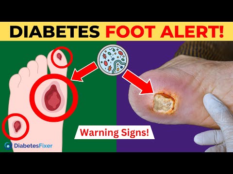 10 Alarming Signs of Diabetes Foot Complications