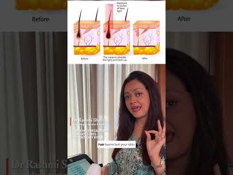 Lasers Hair Reduction: How does it really work?  By Dr Rashmi Shetty