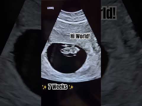 7 weeks pregnant ultrasound #shorts