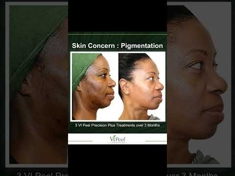 VI Peel for Pigmentation: Stunning Before & After Results at Plantation Med Spa, Florida #shorts