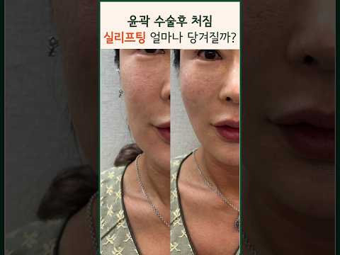 윤곽 양악 수술후 얼굴 처짐 리프팅 개선 방법 전후비교 | 실리프팅 안면거상 울쎄라 #modsclinic #스컬트라