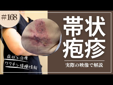 #168    帯状疱疹　訪問看護での治療の様子お伝えします！