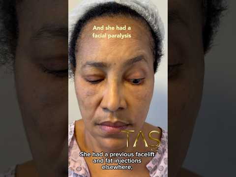 Revision Facelift, Amazing Transformation #drsuleymantas #facelift #revisionfacelift