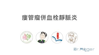 瘻管瘤併血栓靜脈炎