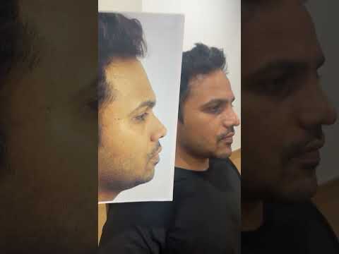 maxillofacial surgery with nose and chin