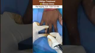 Vitiligo treatment at skinaa clinic #vitiligomodel #vitiligo #shorts #viralshorts  #skinaaclinic