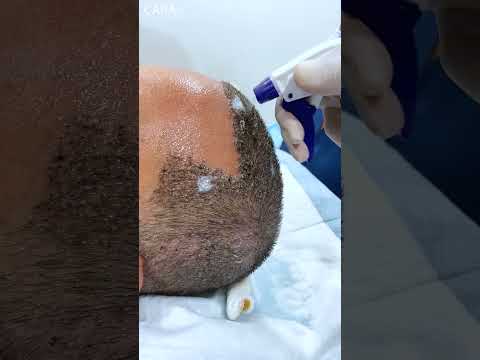 Headwash After Hair Transplant at Cara Clinic