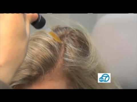 Dr. Alex Khadavi Female Hair Loss for ABC7 News