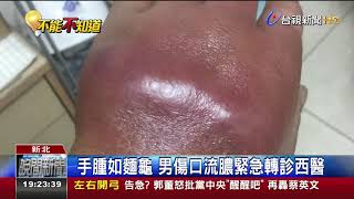 搬重物手腫男針灸惡化蜂窩性組織炎