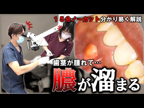 『歯ぐきが腫れて 膿が溜まる…』治療 15分ノーカット　  #根管治療