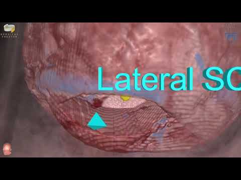 Lateral supracerebellar infratentorial approach for pontomesencephalic cavernous malformations