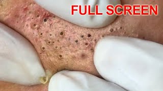 Blackheads removal - Best Pimple Popping Videos