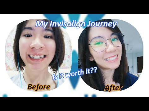 My INVISALIGN Journey -- Is it worth to do Invisalign?? | HEARTTALK #002