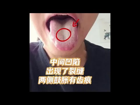 中间凹陷 出现了裂缝 两侧鼓胀有齿痕