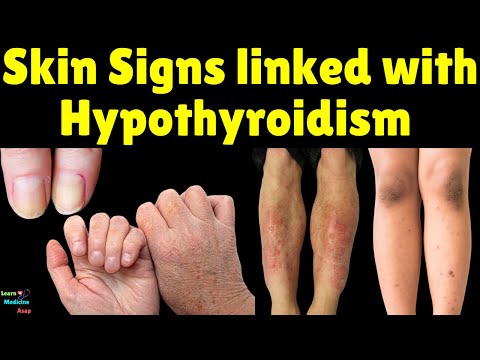 Skin Signs linked with Hypothyroidism (Underactive Thyroid)