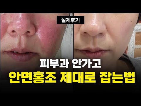 얼굴 열감 내리는 홈케어 완전 정복! 안면홍조 관리법 모두 공개합니다(냉찜질 수분관리팁!