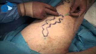 Tumescence for phlebectomy of varicose veins