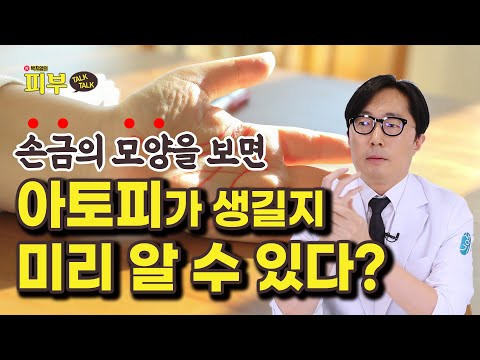 ‘손금’으로 아토피 발생 가능성 예측하는 과학적인 방법 - 박치영의 피부 톡톡 #146