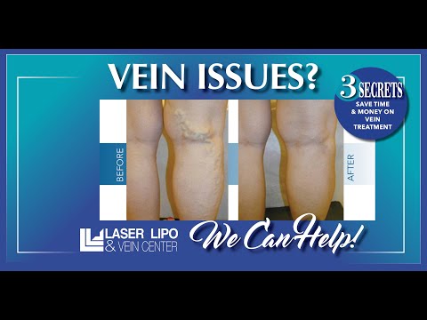 Dr. Wright discusses varicose vein treatments costs secrets in St. Louis MO