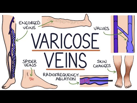 Understanding Varicose Veins