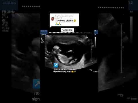 13 Weeks Fetal Kicks #babyultrasound #pregnancyscan